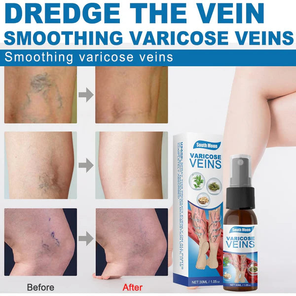 SPRAY ANTI VARICES - ADIOS VENAS  (30 ml) -Últimas 7 Unidades 🔥